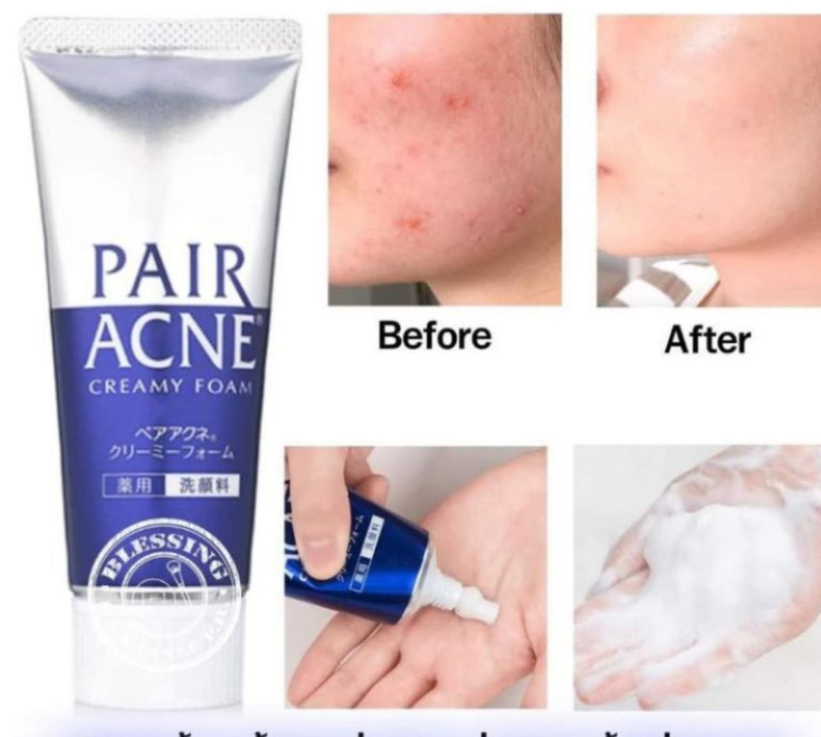 LION - Mousse Crémeuse Anti-Acné 80g