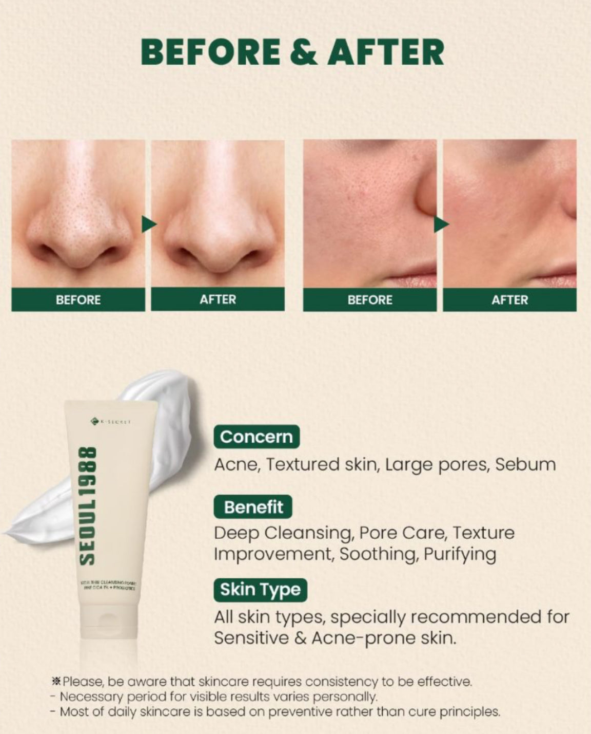 KSECRET - SEOUL 1988 Mousse nettoyante apaisant acné et anti-points noirs : Pin Cica 1% + Probiotiques